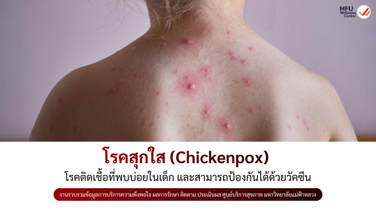 โรคสุกใส (Chickenpox): โรคติดเชื้อที่พบบ่อยในเด็ก และสามารถป้องกันได้ด้วยวัคซีน